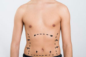 Tummy Tucks for Men in Utah | NuVista Plastic Surgery